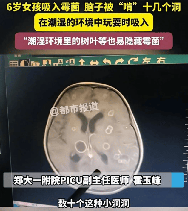 皇冠信用网代理注册_6岁女童发烧17天皇冠信用网代理注册，脑子竟被“啃”出十几个洞！“元凶”家中很常见！